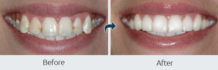 Cosmetic Natural Color Fillings