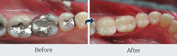 Composite Bonding