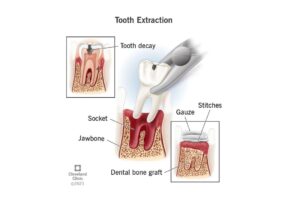Tooth Extraction