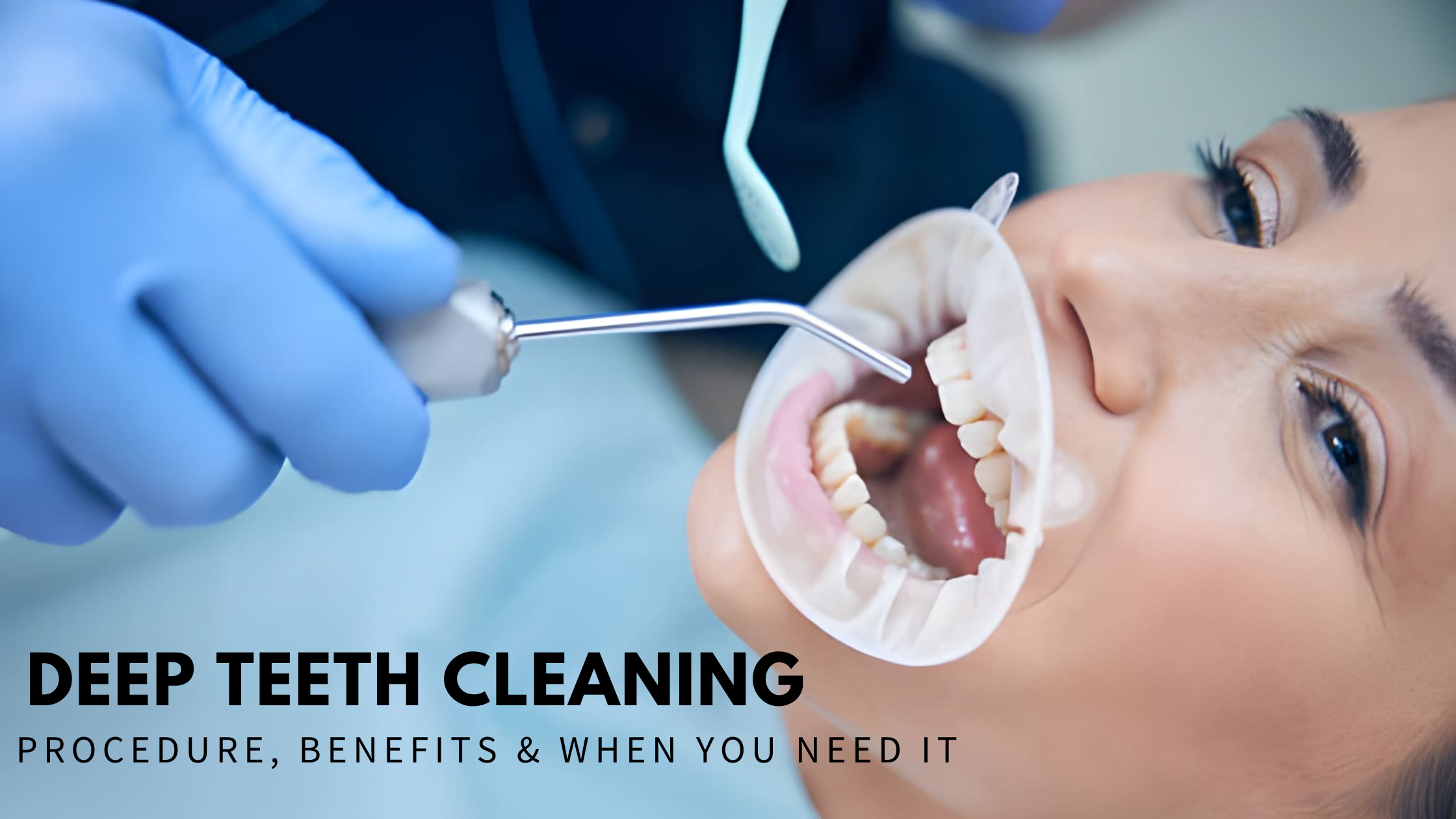 Deep Teeth Cleaning